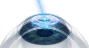 스마일라식의 펨토초 레이저 원리를 보여주는 3D 의학 일러스트